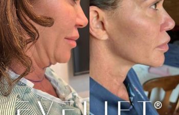 female patient before and after EVELift®