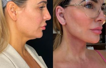 female patient before and after EVELift®