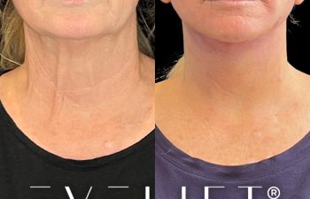 female patient before and after EVELift®