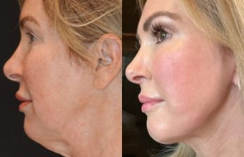 female patient before and after EVELift®