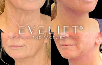 female patient before and after EVELift®