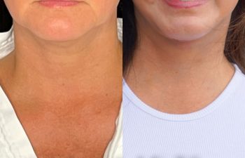 female patient before and after EVELift®