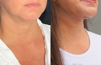 female patient before and after EVELift®