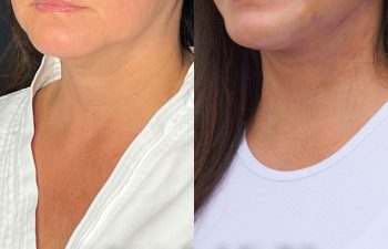 female patient before and after EVELift®
