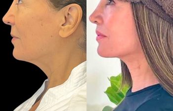 female patient before and after EVELift®