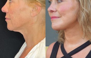 female patient before and after EVELift®