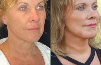 female patient before and after EVELift®