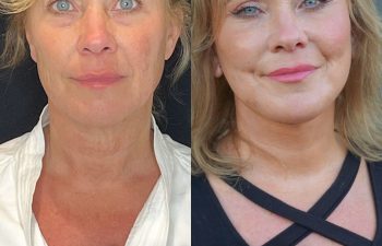 female patient before and after EVELift®