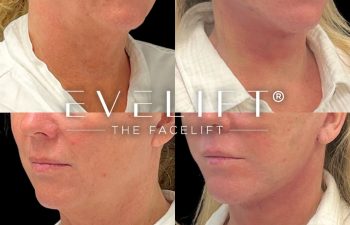 female patient before and after EVELift®
