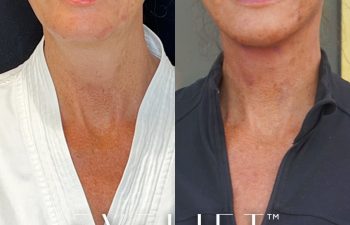 female patient before and after EVELift®
