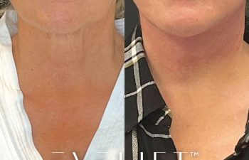 female patient before and after EVELift®