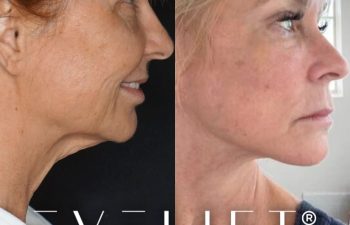 female patient before and after EVELift®