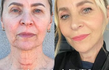 female patient before and after EVELift®