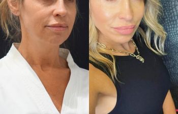 female patient before and after EVELift®