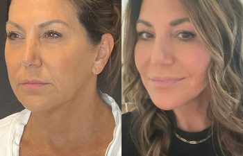 female patient before and after EVELift®
