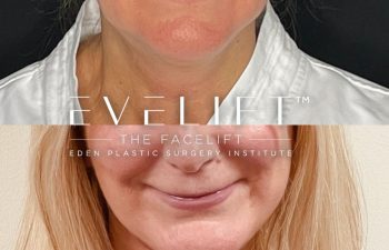 female patient before and after EVELift®