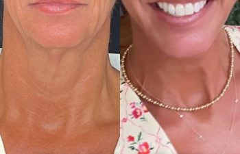 female patient before and after EVELift®