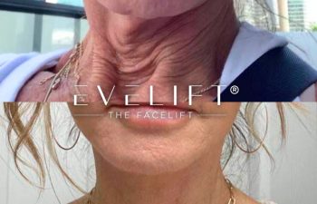 female patient before and after EVELift®