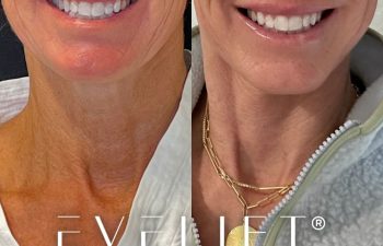 female patient before and after EVELift®