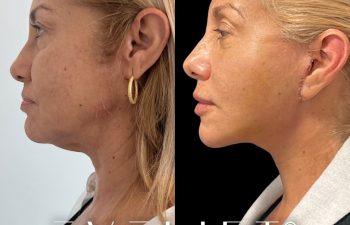 female patient before and after EVELift®