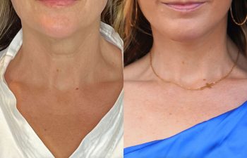 female patient before and after EVELift®