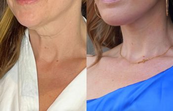 female patient before and after EVELift®