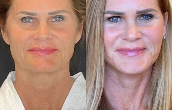 female patient before and after EVELift®