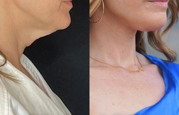 female patient before and after EVELift®