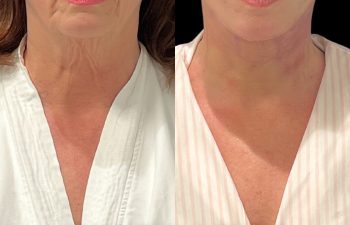 female patient before and after EVELift®