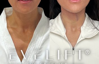 female patient before and after EVELift®