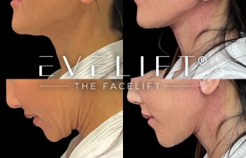 female patient before and after EVELift®
