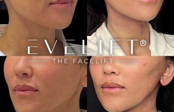 female patient before and after EVELift®
