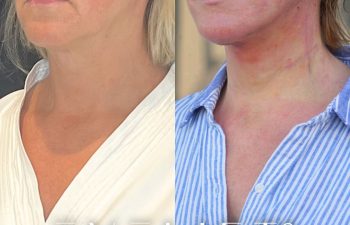 female patient before and after EVELift®
