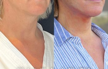 female patient before and after EVELift®