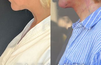 female patient before and after EVELift®