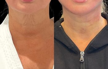 female patient before and after EVELift®