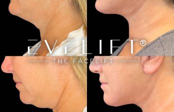 female patient before and after EVELift®