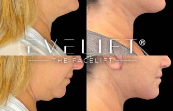 female patient before and after EVELift®