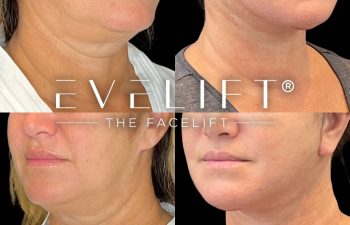 female patient before and after EVELift®