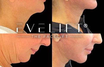 female patient before and after EVELift®
