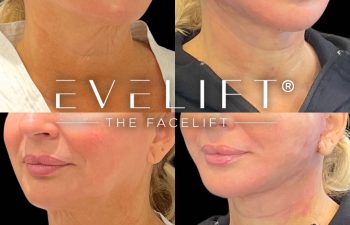 female patient before and after EVELift®