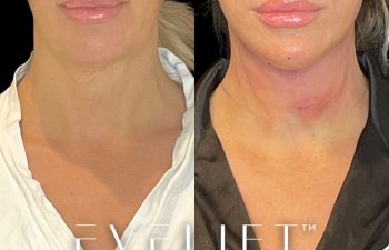 female patient before and after EVELift®