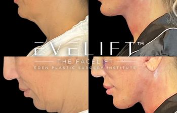 female patient before and after EVELift®