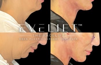 female patient before and after EVELift®
