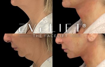 female patient before and after EVELift®