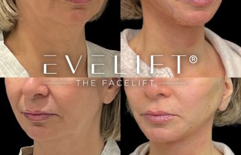 female patient before and after EVELift®