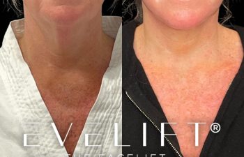 female patient before and after EVELift®