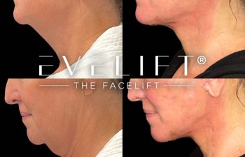 female patient before and after EVELift®