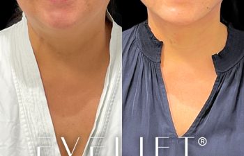 female patient before and after EVELift®