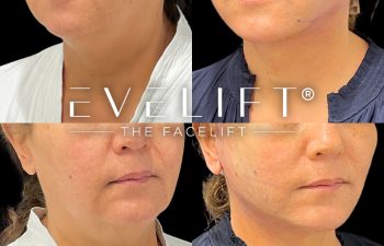 female patient before and after EVELift®
